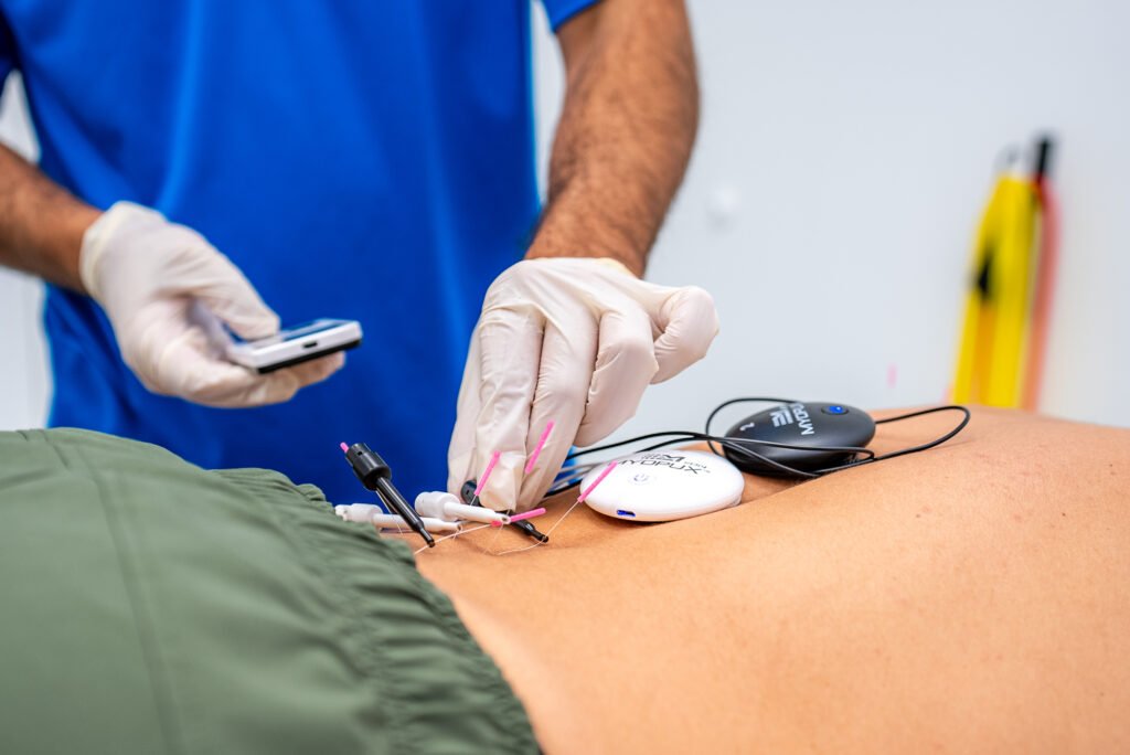 Closeup of a patient receiving a dry needling treatment on their back