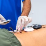 Closeup of a patient receiving a dry needling treatment on their back